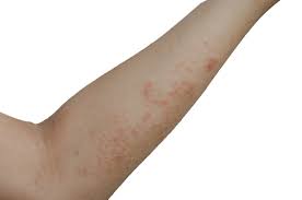 Image result for scabies bite