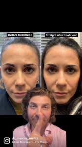 💉Anti-wrinkle Treatment is such a simple yet effective treatment that most  people don't even feel as you can see here 🎥 ——————————————————————————-  It...