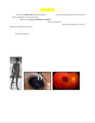 Image result for Homocystinuria