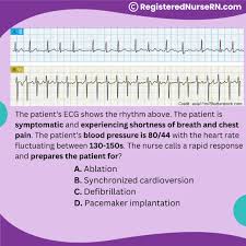 Image result for Synchronized Cardioversion