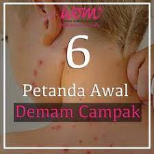 4 obat tradisional campak ini terbuat dari bahan bahan alami apa saja. 6 Petanda Awal Demam Campak