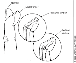 A flexor tendon injury can make it impossible to bend your fingers or thumb. Acute Finger Injuries Part I Tendons And Ligaments American Family Physician