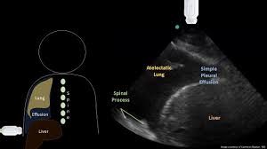 Image result for Parapneumonic Effusion