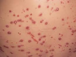 Image result for koebner phenomenon psoriasis