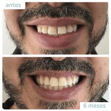 Dentes Tortos Corrigindo Com Aparelho Invisivel Smilink