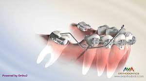 Sentalloy open coil springs were used to exert 150 gm of force for a period of 12 weeks. Orthodontic Treatment For Molar Uprighting Cantilever Spring Youtube