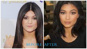 We talk to a woman who had a nose job to find out what it's really like to get plastic surgery. Kylie Jenner Plastic Surgery Pictures Before After