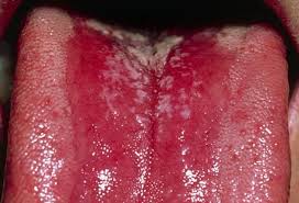 Image result for Mouth ulcers roof of mouth