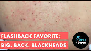 If you aren't already a popaholic (that's what we call the pimple popping community around here) you may be dr. 6kfhzd0xtudffm