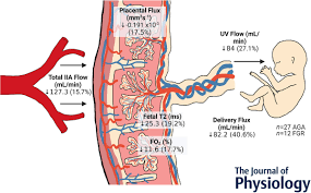 Image result for Delayed Transition from Fetal Circulation