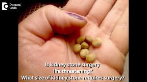 Is Kidney Stone Surgery Life Threatening What Size Of Kidney Stone Requires Surgery Dr Manohar T Youtube