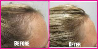 Using an absorbent soft towel that soaks up excess. Vitamins Hair Loss Faster Hair Growth For Women With Thinning Hair Hairlosswomen In 2020 Regrow Hair Fast Hair Treatment Thinning Hair Vitamins
