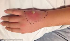 How dangerous are false widow spiders? Teenager Has Chunk Of Her Hand Removed After False Widow Bit Her In The Cinema And Left Her With Terrible Injuries Daily Mail Online