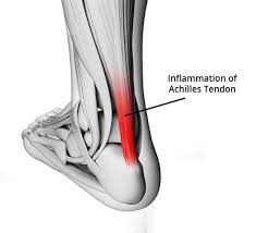 Retrocalcaneal heel bursitis pain in the back of the heel treatment! michigan foot doctors. Achilles Tendon Pain Back In Action