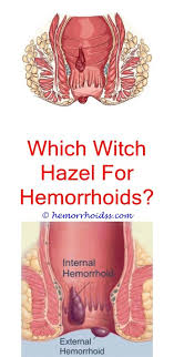 What Causes Hemorrhoids To Flare Up Hemorrhoid Remedies Bleeding Hemorrhoids Home Remedies For Hemorrhoids