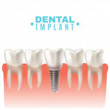 Dental Implant Pain How Long Does It Last After Procedure Signature Smile