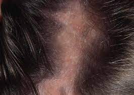Frequently scratching or applying drying chemicals to the affected area can also damage hair follicles. Was Candida The Cause Of Your Hair Loss Quora