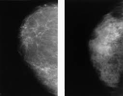 Mammograms provide a look inside the breast to help doctors (radiologists) detect breast cancer, often in the early stages when it's most treatable. Mammogram Images Normal Abnormal And Breast Cancer
