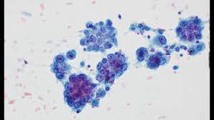 The establishment that the effusion is malignant, and then a diagnosis of the mesothelial . Mesothelioma Cytology Youtube