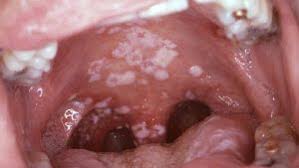 Image result for oral thrush symptoms roof of the mouth