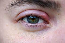 Stye On Your Eye | How To Get Rid Of An Eye Stye | Michigan Eye Institute