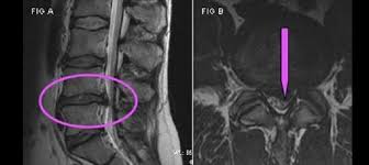 Sciatica Lumbar Radiculopathy Wake Spine Pain