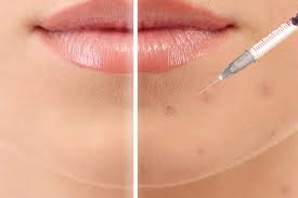 Nov 29, 2017 · the corticosteroids will work within a couple of days to a week to reduce inflammation in the area caused by the mentioned conditions. How Does A Cortisone Injection Work The Dermatology Specialists