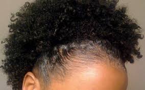 Grow your hair long, past your ears, and leave it unstyled so it looks natural. Protecting Your Thinning Edges