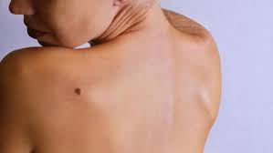 How to check for skin cancer. The Three Kinds Of Skin Cancer How To Spot Them Wear