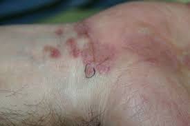 Hypertrophic lichen planus can be scaly. Pathology Outlines Lichen Planus