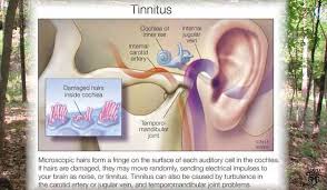 Image result for Tinnitus
