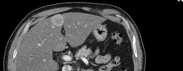 Despite this, pancreatic cancer is among the deadliest types of cancer, which is why it's extremely important to know and recogni. Https Oncologypro Esmo Org Content Download 159268 2912083 File 2018 Esmo Preceptorship Prostate Cancer Participant Clinical Case Liver Metastasis Sara Coelho Pdf