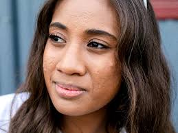 Whiteheads: How to remove, causes, pictures, and more