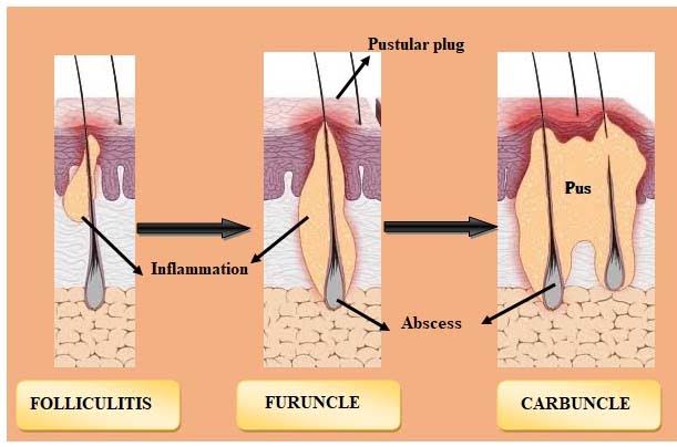 Skin and Soft Tissue Infections: Current Advancement in Epidemiology,  Pathogenesis and Management - Journal of Pure and Applied Microbiology