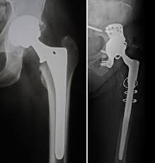 Having a double hip replacement reduces the risk of many complications that come along with anesthesia. Revision Total Hip Replacement Orthoinfo Aaos