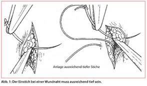 Zeigt eine genähte schnittwunde am 14 tag unmittelbar vor entfernung der fäden. Akute Hautwunden Versorgen Eine Hausarztliche Aufgabe Doctors Today