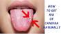 Discharge What Does A Yeast Infection Look Like