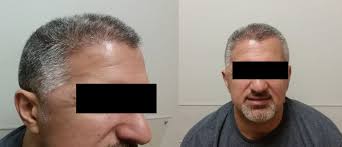 Use of an Acellular Dermal Matrix Graft to Address a Contour Deformity in  the Temporal Fossa: A Novel Application