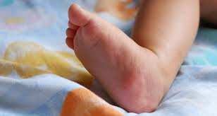 Image result for ant bite