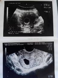 Siklus antar haid kurang dari 21 hari. Penebalan Dinding Rahim Awal Kehamilan Salam Sehat