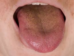 Image result for yellow tongue infection