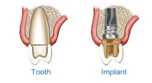 Why do dental implants cost so much? Dental Implants Cost Procedure And Materials To Replace Your Teeth