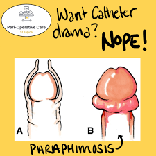 Image result for Paraphimosis