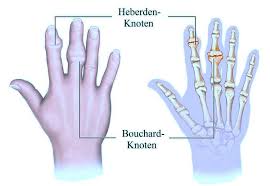 Geschwollener Entzundeter Finger Kinder Was Tun Operation Ursache Gelenk