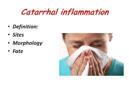 The term catarrh is found in medical sources from the united kingdom.3 the word has also been common in the folk medicine of appalachia, where medicinal. By Dr Ghada Ahmed Lecturer Of Pathology Benha Faculty Of Medicine Ppt Video Online Download