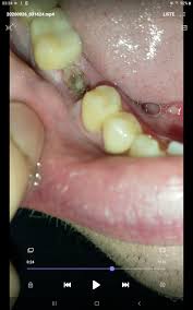 Image result for Alveolitis sicca)