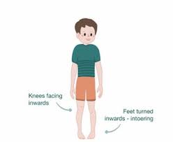 Image result for In-Toeing