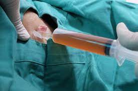 Seroma Por Que Se Produce Y Como Se Trata Mejor Con Salud