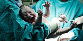Ein geplanter kaiserschnitt für eine unkomplizierte zwillingsschwangerschaft sollte nicht vor 38 wochen durchgeführt werden, da dies das risiko für atemprobleme bei diesen babys erhöht. Wunschkaiserschnitt Alle Fakten Fur Ihre Entscheidung Familie De