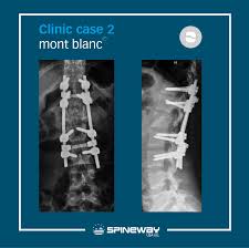 Posted 4 years ago, 3 users are following. Clinical Case Before And After Woman 20 Years Old L1 Compression Fracture You Lead The Way We Find The Way Spinewa Lead The Way Spine Surgery Clinic